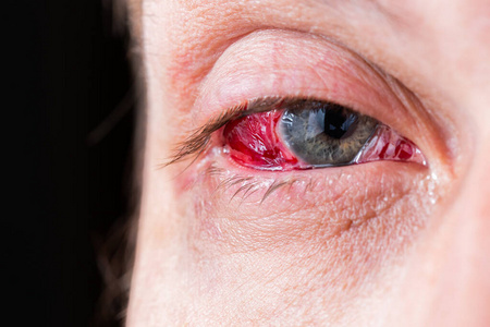 选择性聚焦术后重度炎症眼特写镜头照片