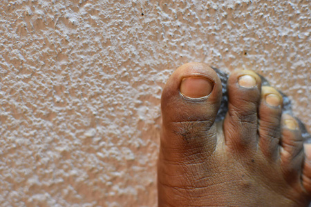 成年男子脚趾.希腊脚趾形状,通常被称为火焰脚或火脚.照片