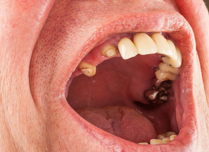 嘴里缺了一排牙齿照片