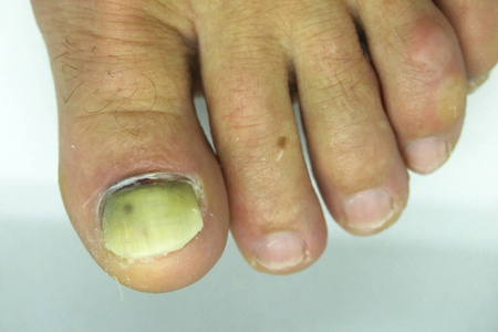 脚趾甲受损。拇指上的男人。脚部丑陋，受伤，指甲断裂。