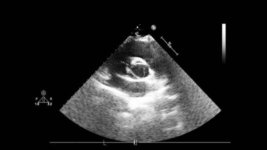 带有心脏图像的超声波机器屏幕。