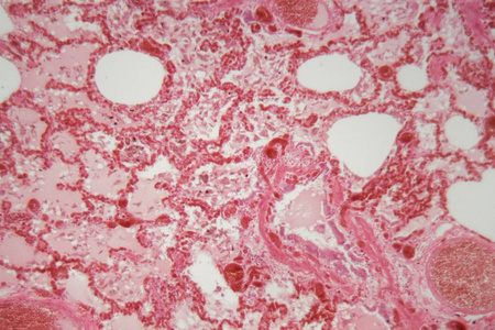 Lung tissue with pneumonia infection caused by flu Viral pneumo