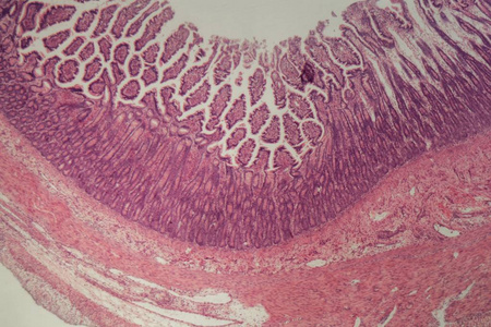 小肠结肠炎大肠切片有炎症(结肠炎)的显微镜照片.照片