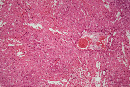 白色照片逼真矢量插图中分离的植物细胞显微镜下肝组织淀粉样变性.