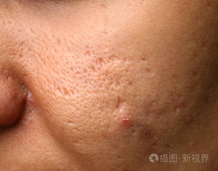 面部皮肤发炎 痤疮 皮肤上有丘疹 疤痕和脱皮 照片 正版商用图片2695q4 摄图新视界