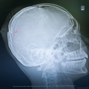 颅骨骨折x线图片图片