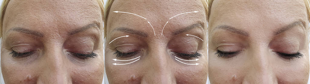 美容师 注射 眼睛 塑料 箭头 修饰 面部 女人 成人 皮肤