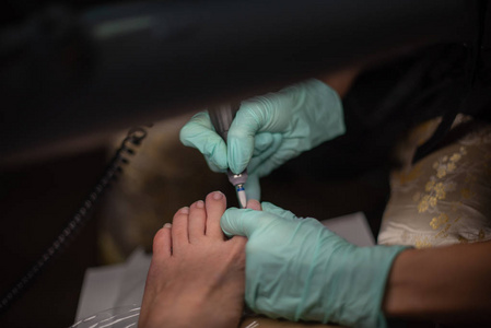脚部医生治疗脚趾甲真菌。足病学治疗。足病学治疗。
