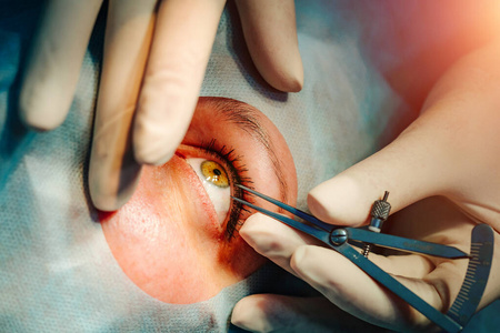 激光视力矫正。一个病人和一个外科医生在手术室做眼科手术。睁开眼睛。病人在无菌覆盖下。特写