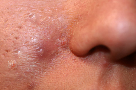 面部皮肤发炎.痤疮.皮肤上有丘疹.疤痕和脱皮.照片