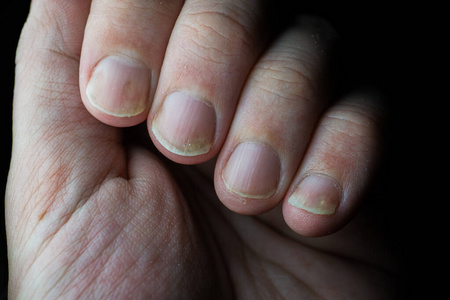 银屑病是一种影响指甲和皮肤的自身免疫性疾病。银屑病指甲特写在黑暗的背景。