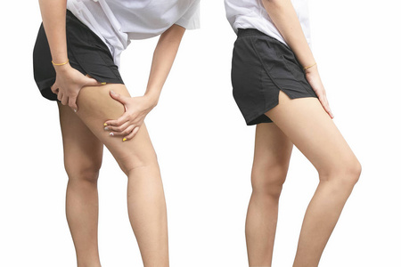 治疗前后女性臀部孤立性白背