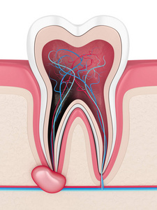 牙龈囊肿牙齿的三维重建