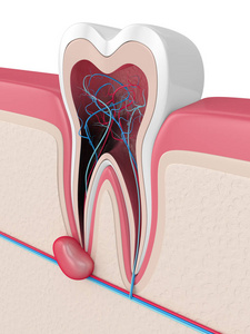 牙龈囊肿牙齿的三维重建图片
