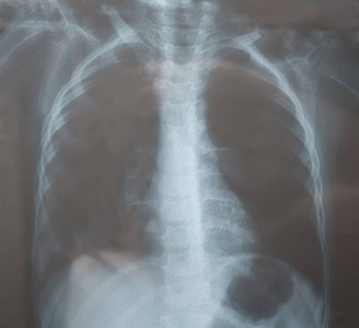 儿童x光片，用于检查肺部。肺炎。