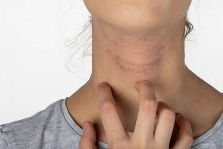 手指皮炎症状女孩颈部皮肤过敏发痒.