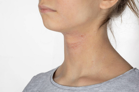 过敏性皮炎湿疹图片