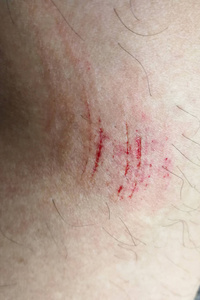 纸巾上有血因意外擦伤导致大腿上有血迹的疼痛瘀伤照片