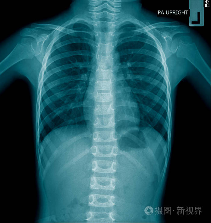 human chest x-ray