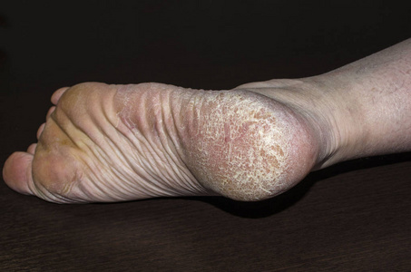 玉米老茧裂缝在脚跟脚特写.皮肤干燥问题.照片