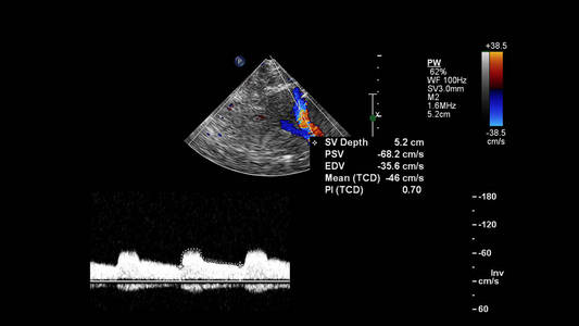 多普勒 病人 办公室 计算机 技术 主动脉 超声波 二尖瓣
