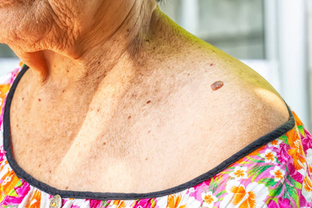 纤维瘤皮肤标签或肩峰或软纤维瘤照片