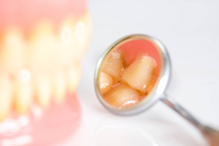 假牙牙医检查一个旧假牙在牙科镜，特写。