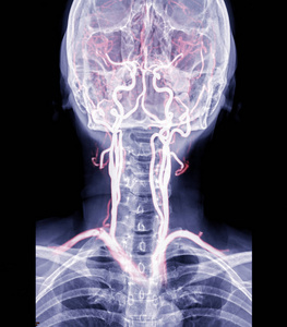颈动脉 伤害 扫描 脊柱 医学 科学 疾病 人类 解剖 关节炎