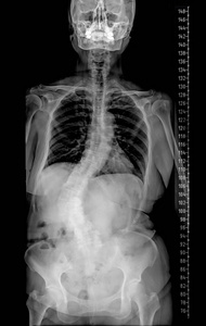 骨架 曲线 科学 扫描 形象 椎骨 射线 骨骼 病人 窗帘