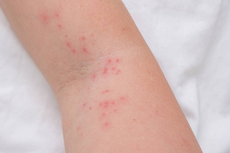 女性手臂上的皮疹,过敏反应引起的瘙痒丘疹,反应,过敏概念和皮肤病学