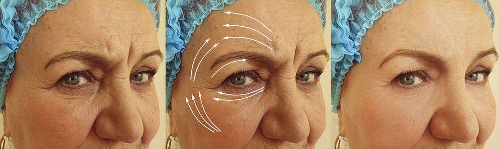 紧张 病人 面对 医学 胶原蛋白 外科手术 振兴 眼睑成形术