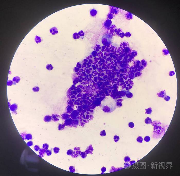 炎症细胞组腹水标本