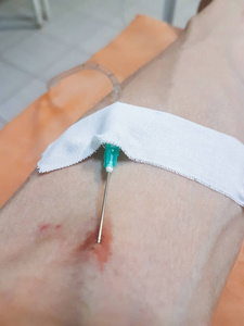 医用滴管通过针头将药物直接注入医院的静脉