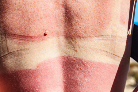 晒伤的皮肤图片