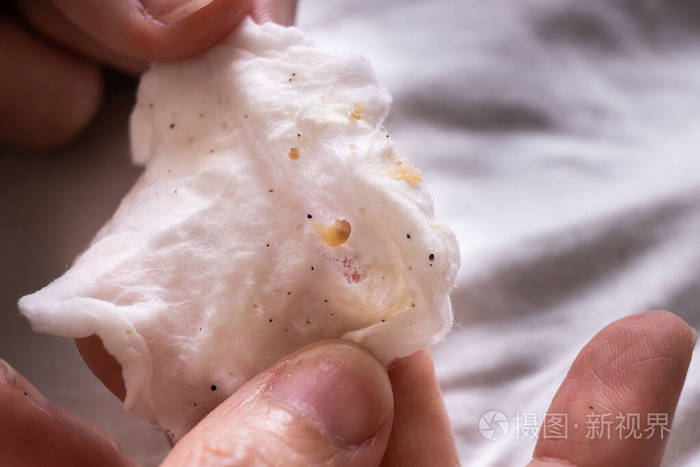 从青少年脸上挤出来的白头和黑头脓液