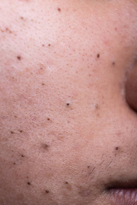 青少年脸颊上丑陋的粉刺黑头照片