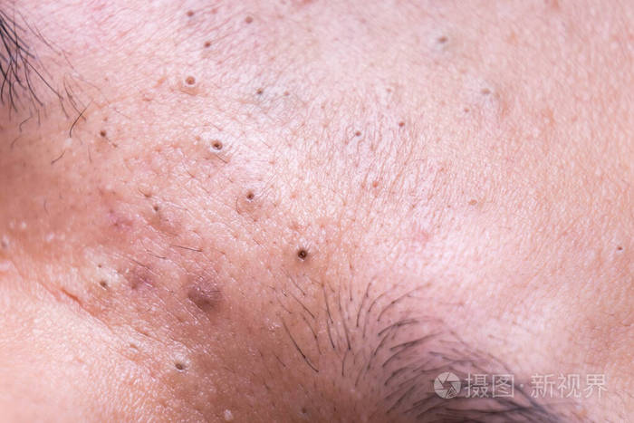 青少年鼻梁上丑陋的粉刺黑头