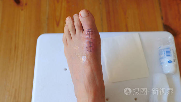 足部术后缝合