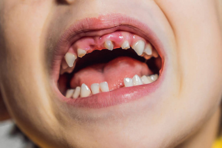 儿童牙齿问题照片