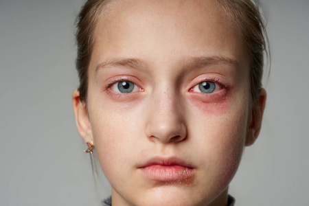 过敏反应，皮疹，近距离观察一个女孩的脸。眼睛和嘴唇皮肤发红和发炎。免疫系统疾病。