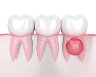 牙龈囊肿牙齿的三维重建图片
