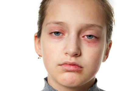 过敏反应，皮疹，近距离观察一个女孩的脸。眼睛和嘴唇皮肤发红和发炎。免疫系统疾病。