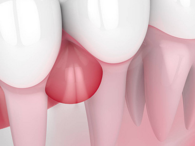 牙龈囊肿牙齿的三维重建