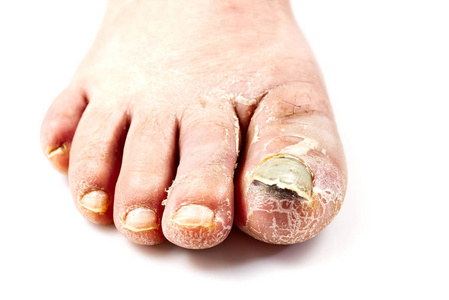 脚上有病的钉子。脚趾甲真菌分离白色。脚趾甲酸痛，指甲真菌特写照片