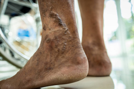 患有静脉曲张,血管疾病,蜘蛛静脉,浅静脉问题,老年人皮肤肿胀,肌肉