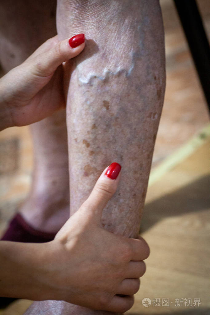 麻风病老人的特写