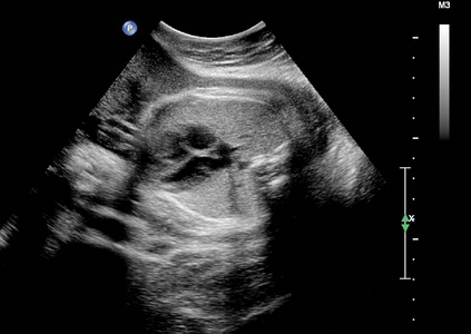妊娠3个月胎儿的超声检查照片