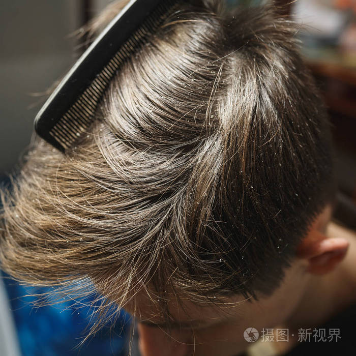 黑发男人头上的头皮屑