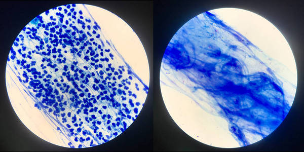 痰涂片检查分枝杆菌肺结核.左否定照片