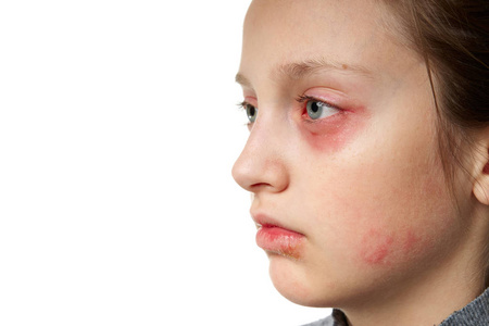 免疫系统疾病过敏反应,皮疹,近距离观察一个女孩的脸.